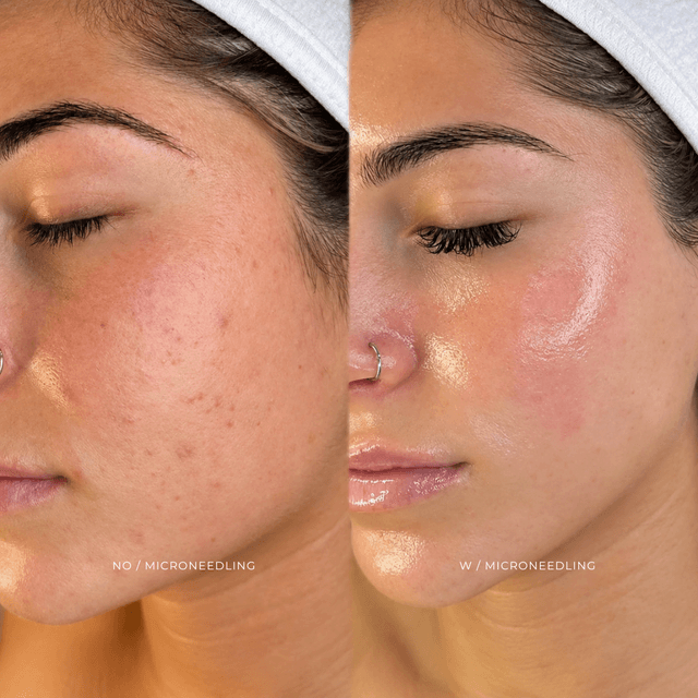 MICRONEEDLING + PLASMA PRP LUXURY at EROXSPA in Houston, TX